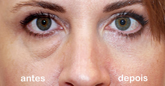 Tipos de Lentes Ópticas - HOCO - Hospital de Olhos do Centro Oeste